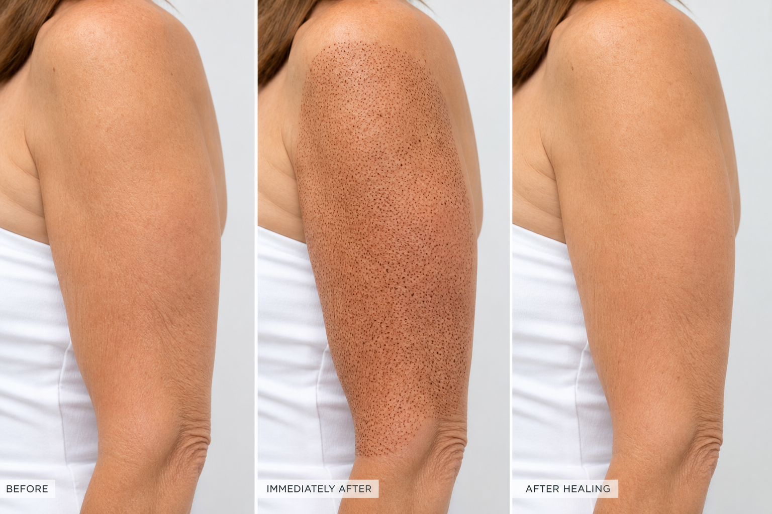 Fibroblast body: before, immediately after with carbon crusts, and after healing on the arm